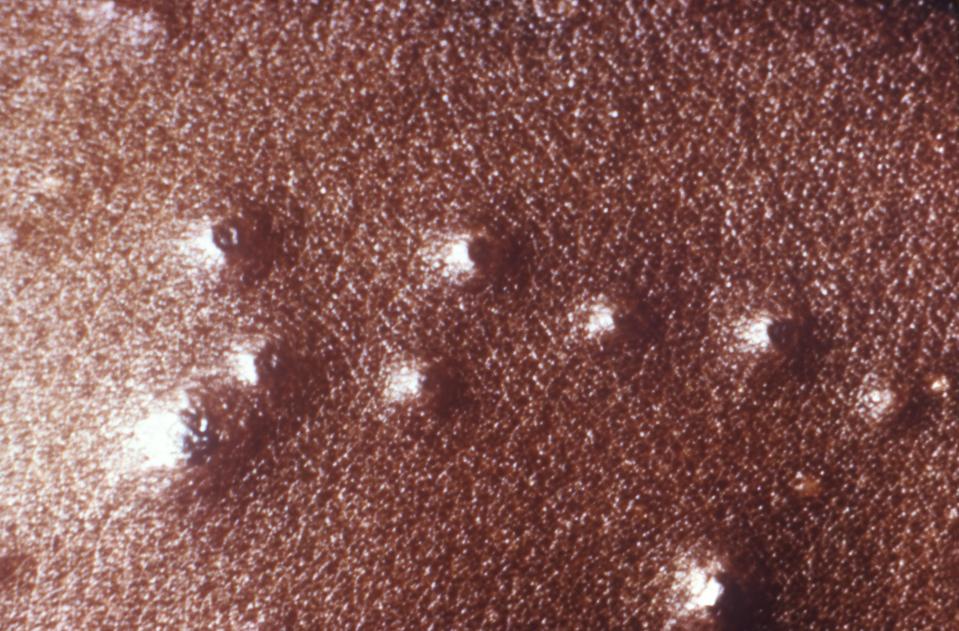FDA Approves TPOXX To Be The 1st Drug For Smallpox
