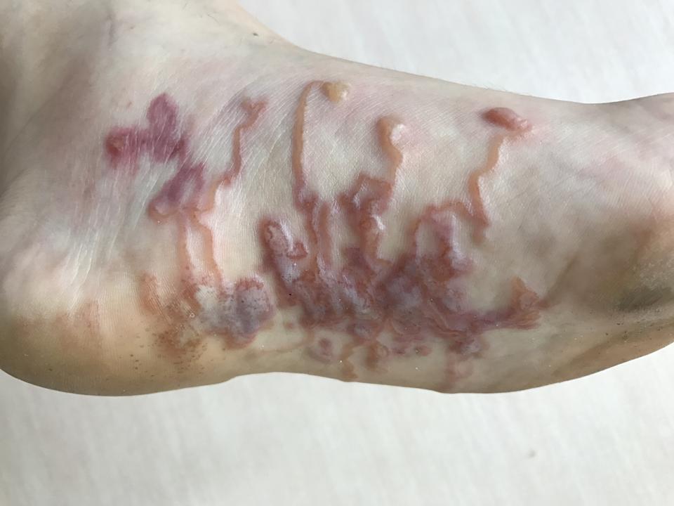Image result for hookworm