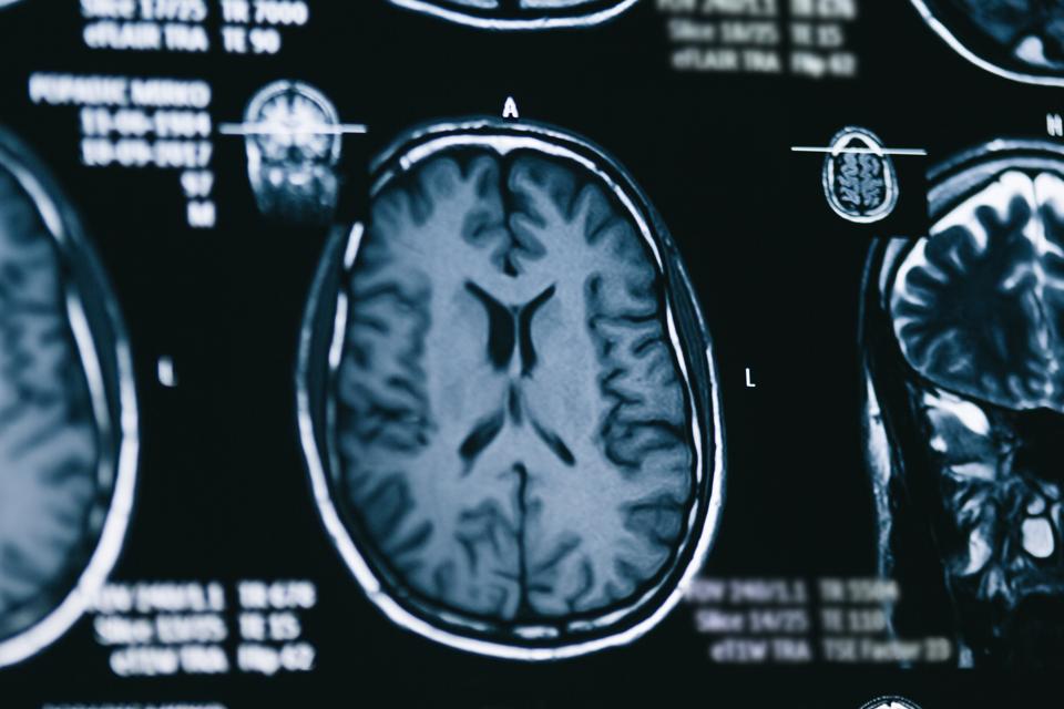 How An Alzheimer Treatment's Success Highlights The Failures In Alzheimer's Drug Research