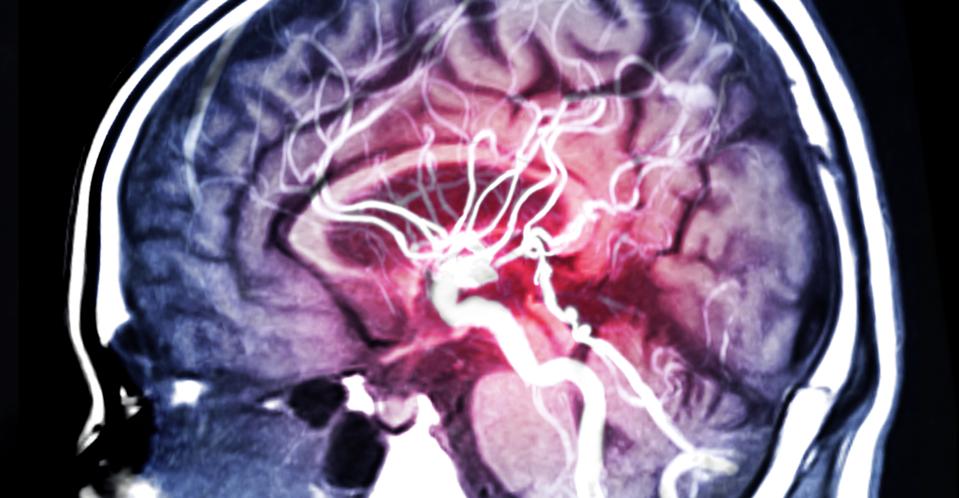 Magnetic resonance angiography