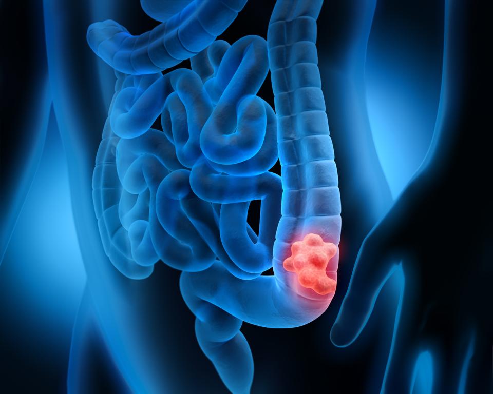 What To Get Someone With Colon Cancer What To Get Someone With Colon Cancer