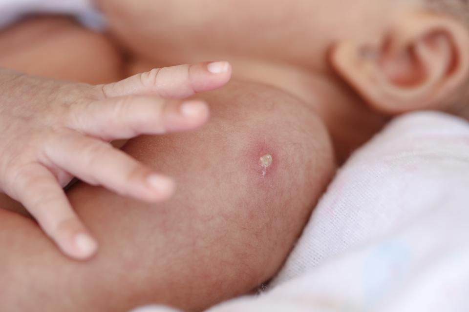 Close up of reaction of Bacillus Calmette Guerin or BCG vaccination infants.
