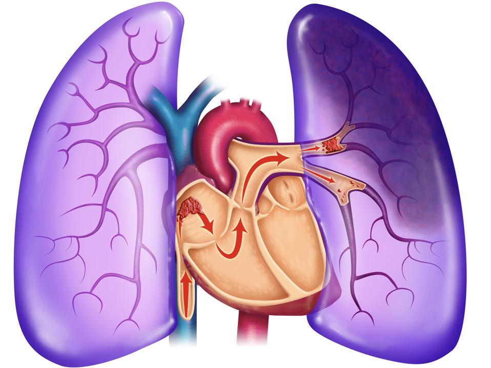 Download Could Blood Thinners Be Crucial For Patients With Covid 19 Related For iPhone Get Wallpaper Could Blood Thinners Be Crucial For Patients With Covid 19 Related Free