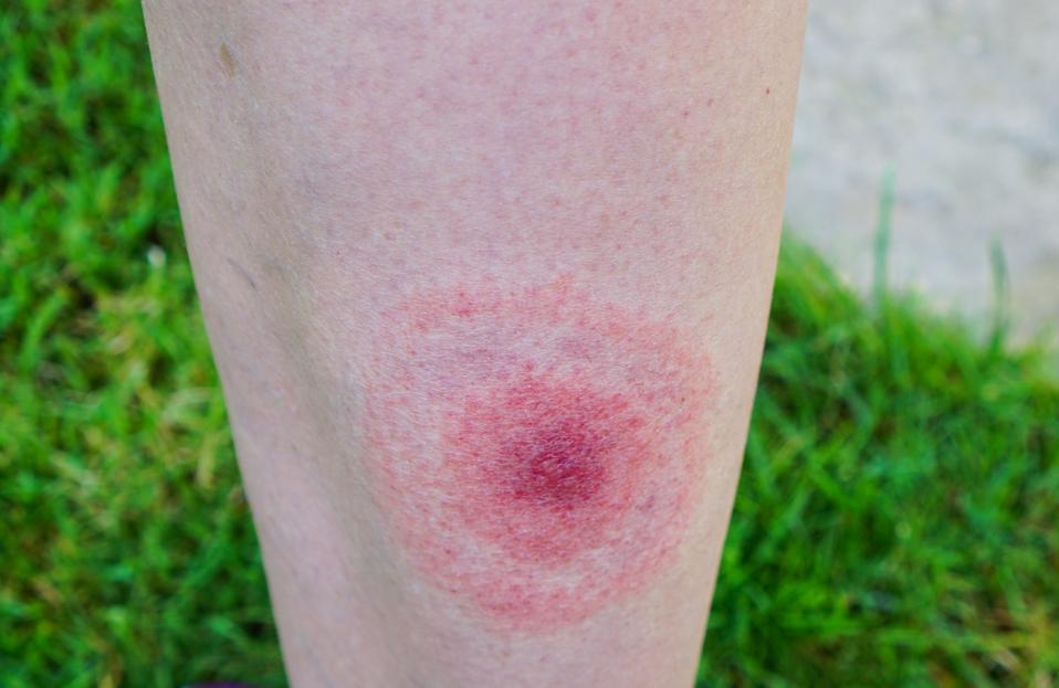 Lyme disease, Borreliosis or Borrelia, typical lyme rash, spot.