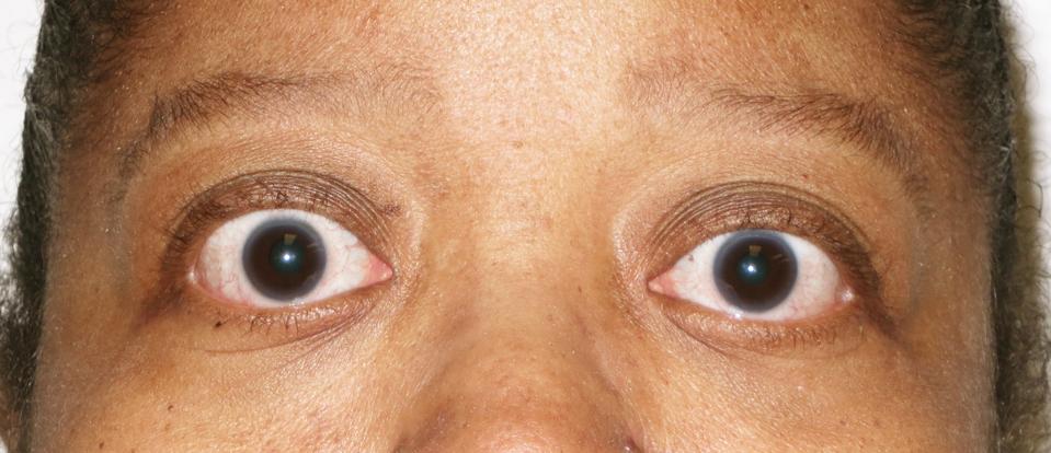 FDA Approves First Drug For Treatment Of Thyroid Eye Disease
