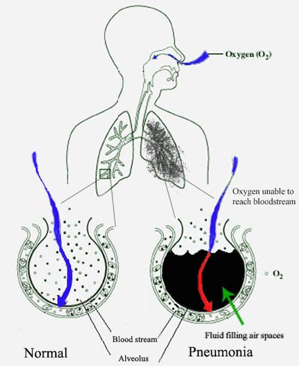 New_Pneumonia_cartoon