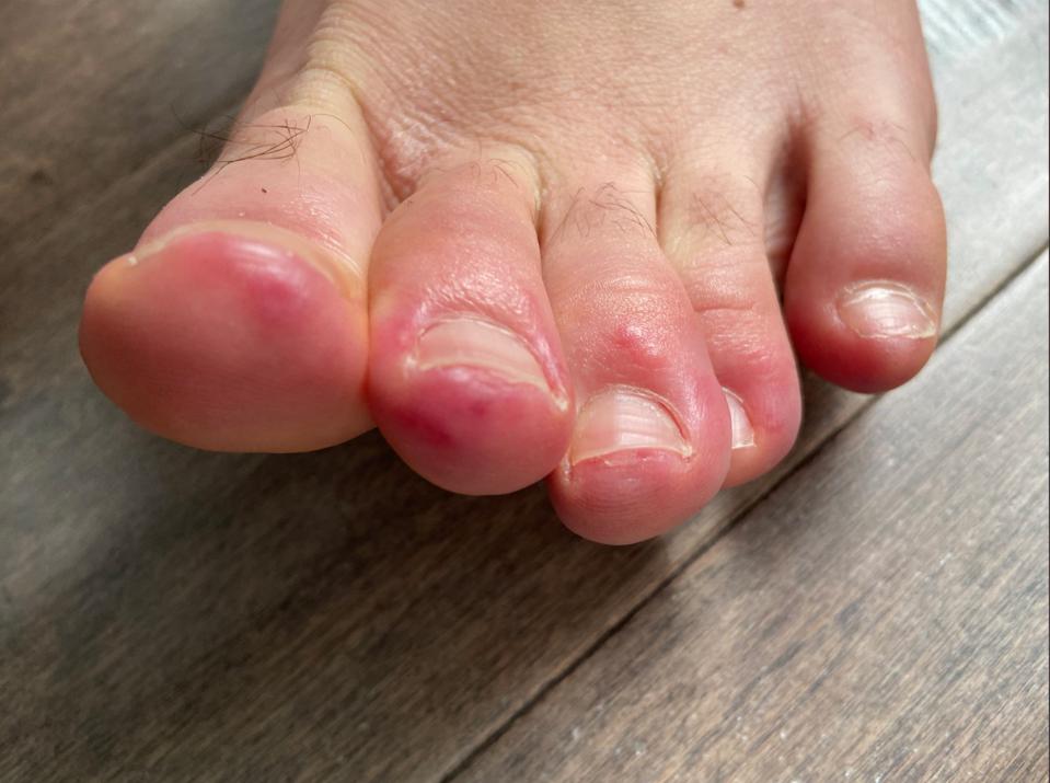 Toes with red spots from Covid19 infection