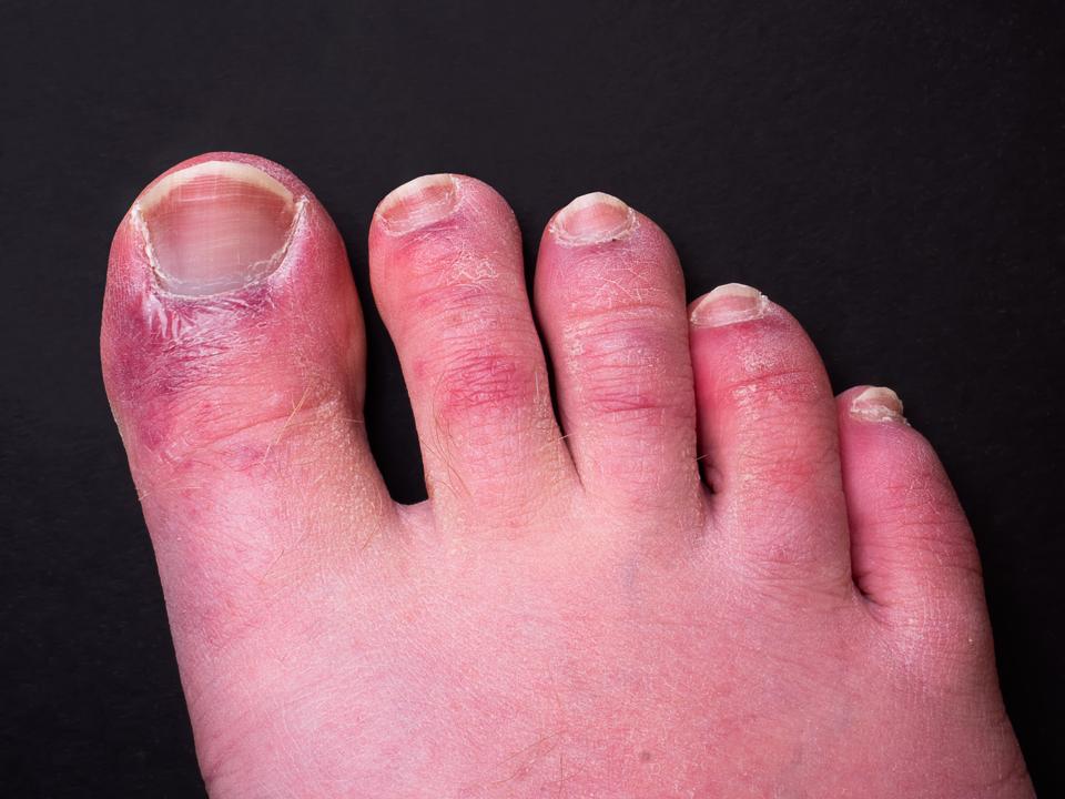 Covid Toes Are Caused By Coronavirus Infecting The Lining Of Blood covid-toes-are-caused-by-coronavirus-infecting-the-lining-of-blood