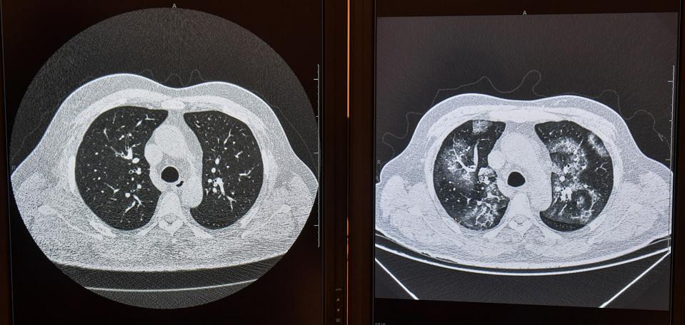 BRAZIL-HEALTH-VIRUS-DIAGNOSIS-ARTIFICIAL INTELLIGENCE