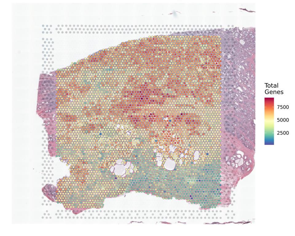 A section of prostate cancer tissue