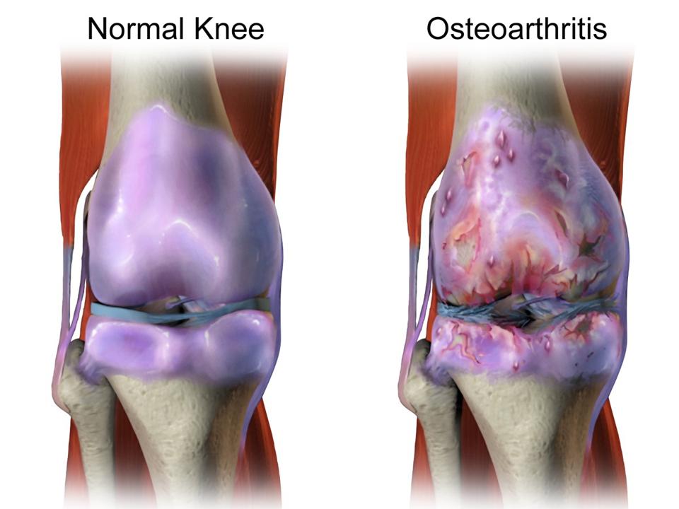 Knee with healthy cartilage beside knee with deteriorated cartilage.