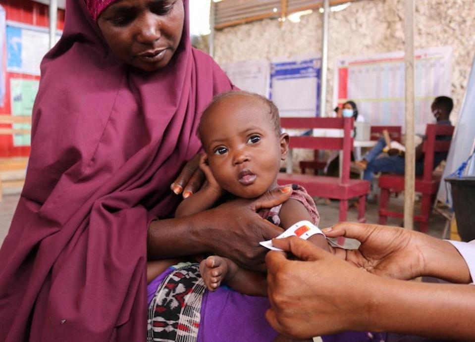 UNICEF Warns 1.84 Million Somali Children Face Acute Malnutrition as Iran War Disrupts Aid