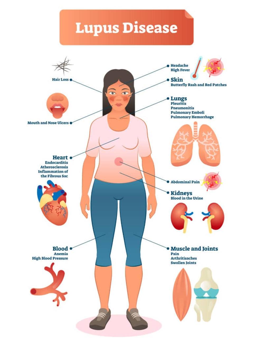 lupus symptoms