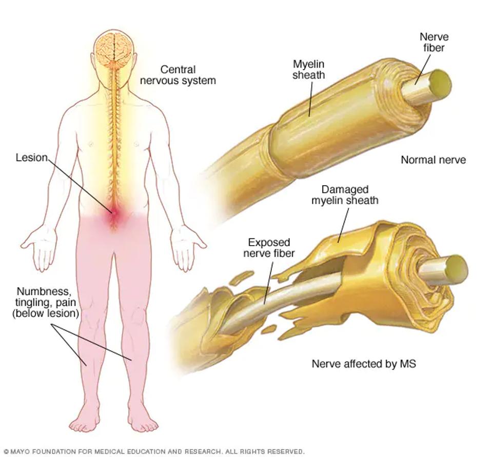 CAR T Therapy, A Promising New Therapy For Multiple Sclerosis? CAR T Therapy, A Promising New Therapy For Multiple Sclerosis?