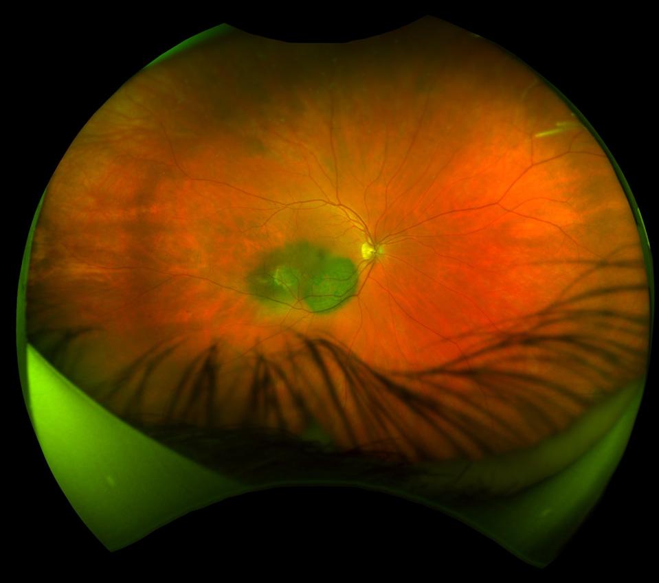 Melanoma
