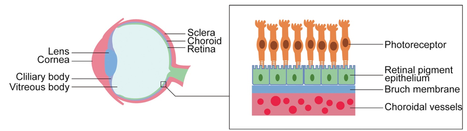 Figure 1: In age-related macular degeneration, nutrients are unable to travel from the choroidal blood vessels to the photoreceptors, causing the death of photoreceptors and blindness.