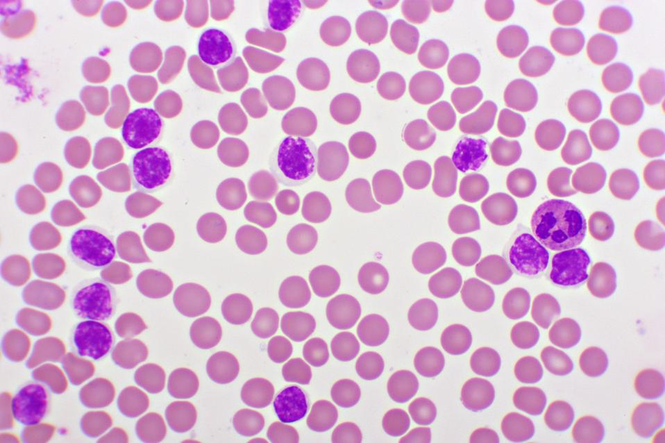 Picture of acute lymphocytic leukemia or ALL cells in blood smear