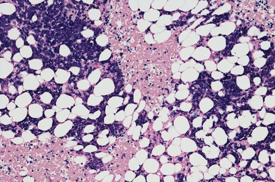 Micrograph of myeloma tumor from bone marrow biopsy