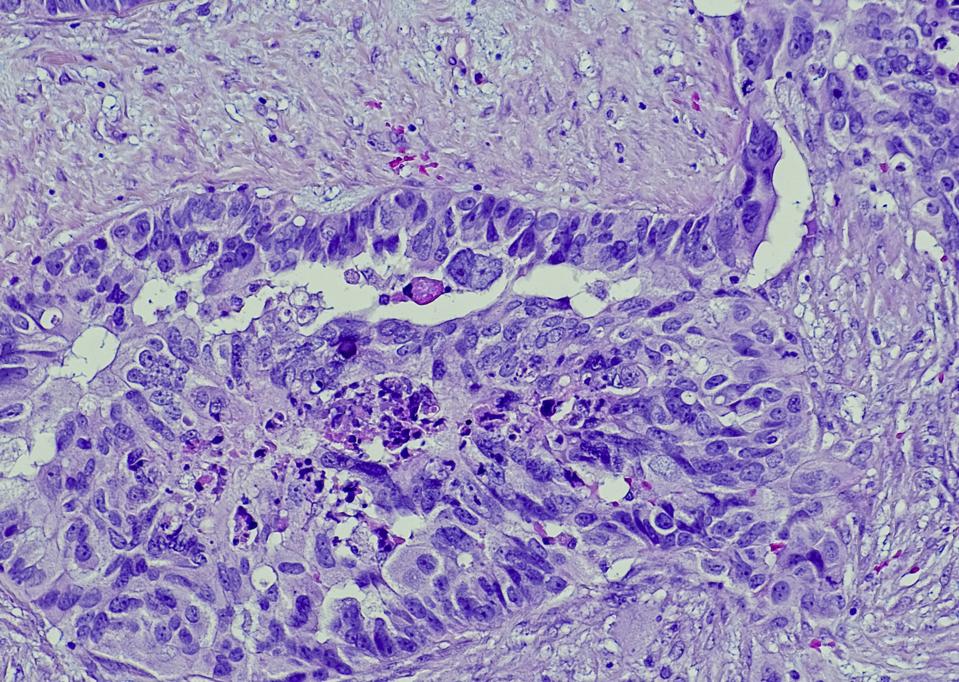 Serous carcinoma, ovary, metastatic soft tissue
