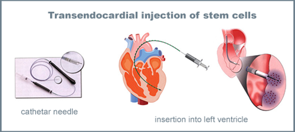 diagram of transendocardial stem cell injection