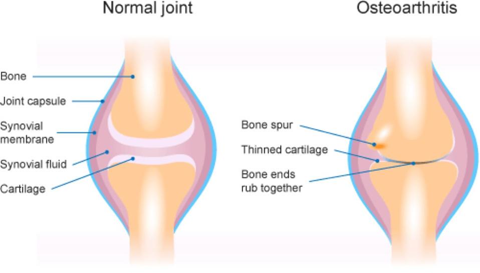 osteoarthritis joint