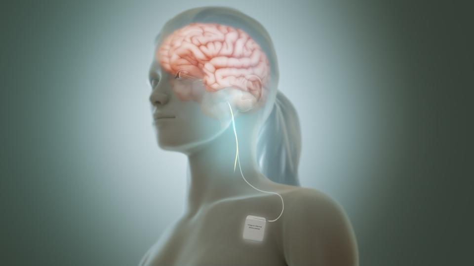 Vagus_nerve_stimulation