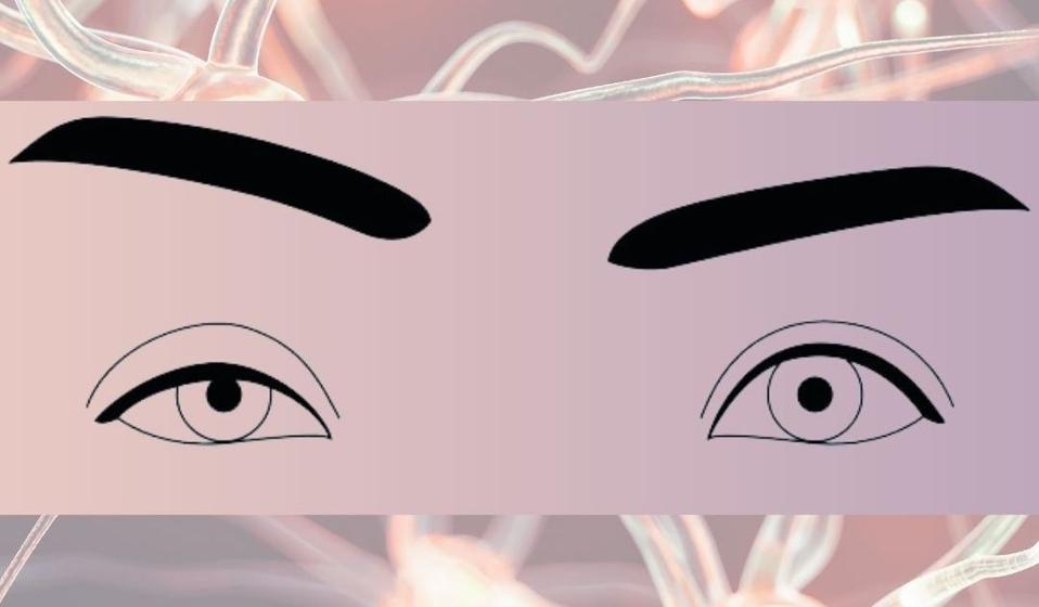 Ptosis, Eye dropping Myasthenia Gravis