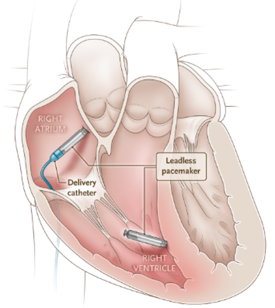 Fixed Rate Pacemaker Restoring Cardiac Function With Dual-Chamber Leadless Pacemakers – ACCESS