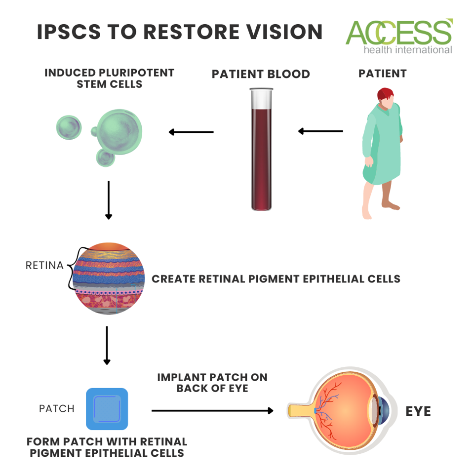 Induced Pluripotent Stem Cells For Age-Related Macular Degeneration