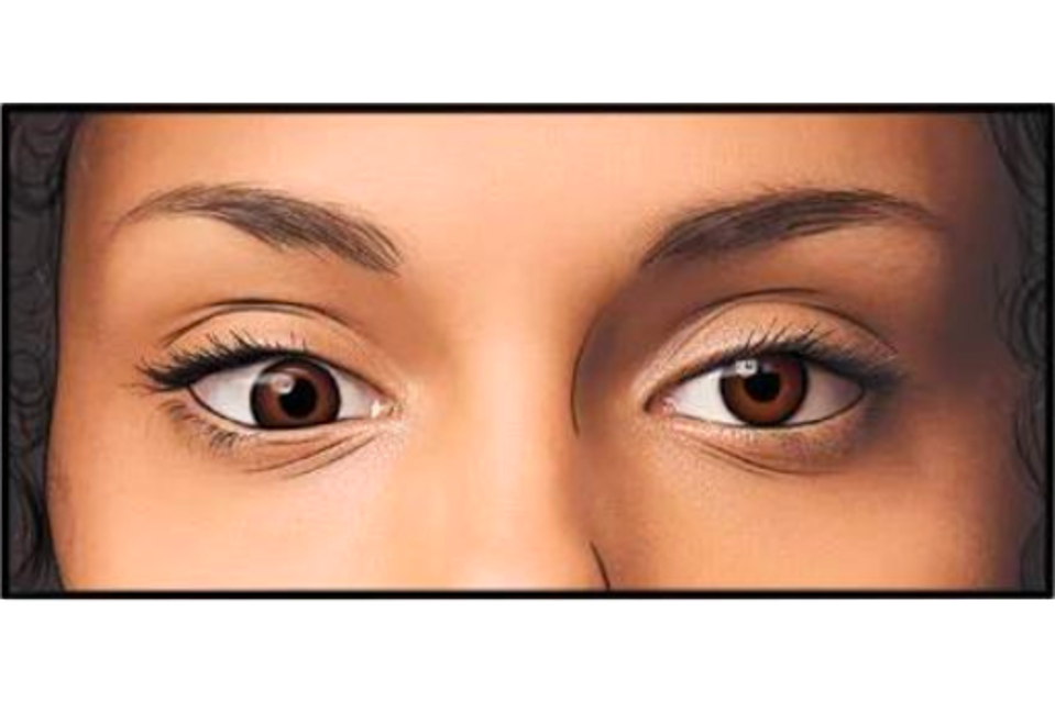 Explore Diverse Treatment Options For Amblyopia Or Lazy Eye