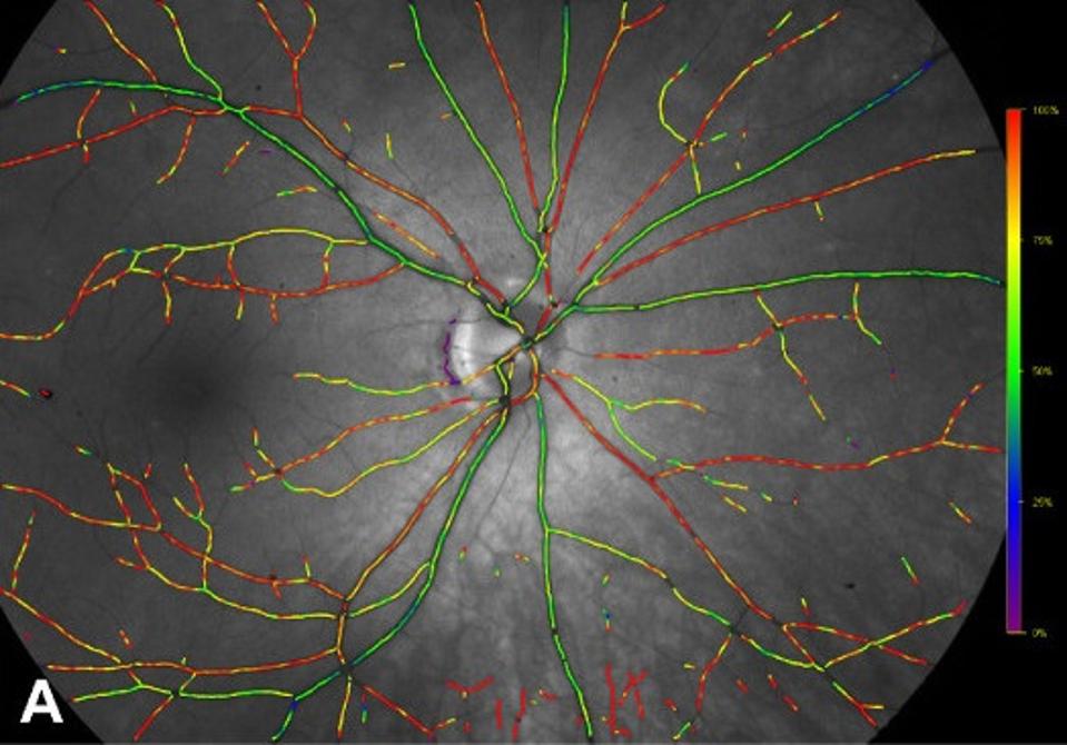 Color-coded oximetry vessel map