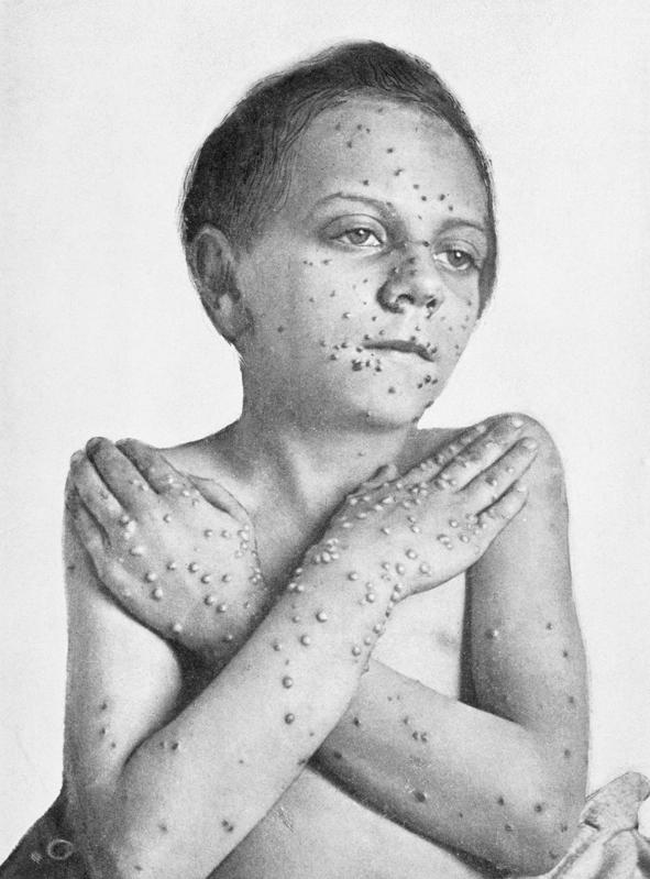 Will Destruction Of Smallpox Virus Get Postponed Again?