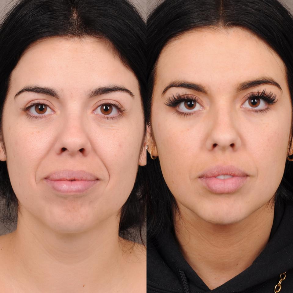 Got Dark Circles? Consider A Safer Alternative to Under-Eye Filler