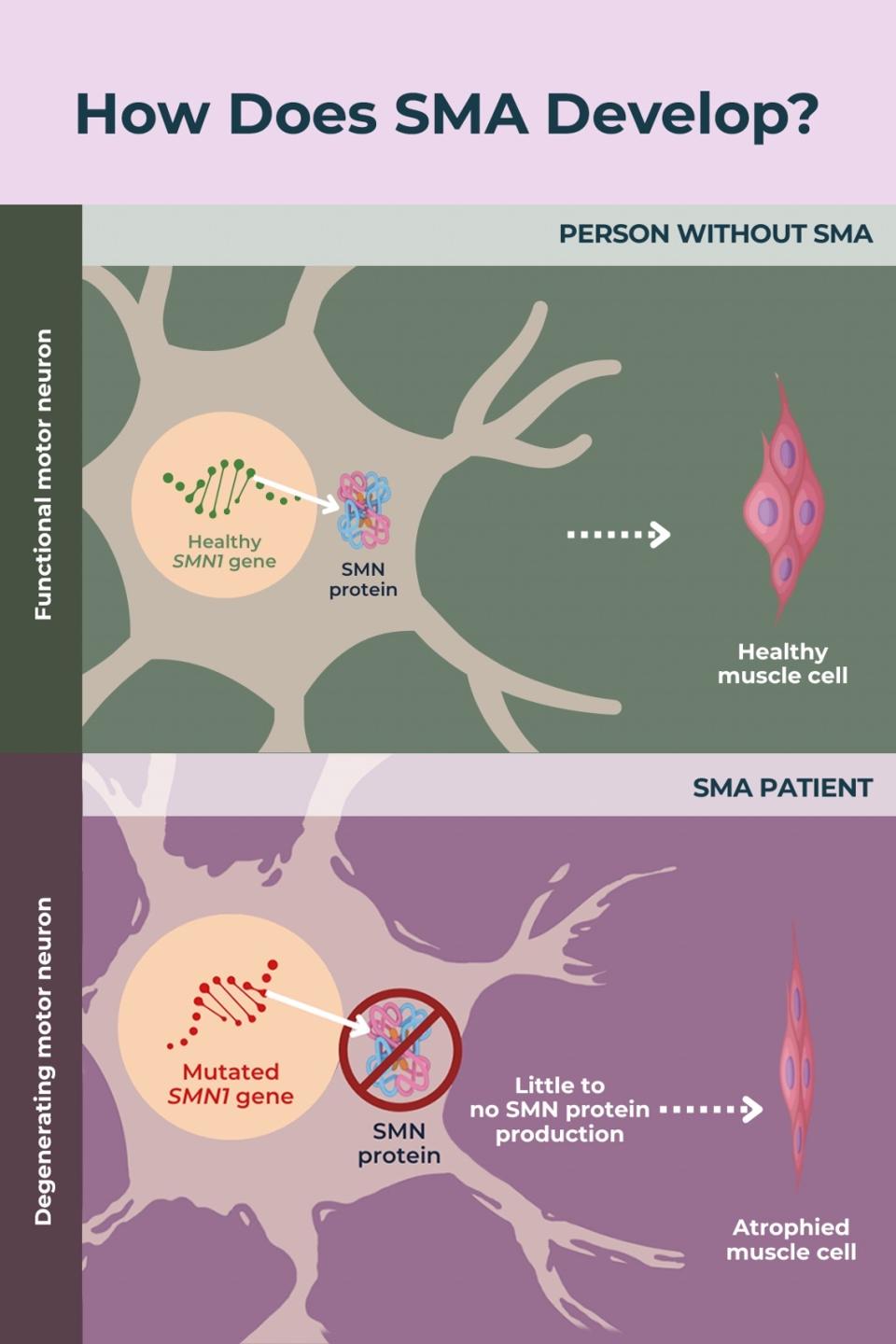 How SMA develops 