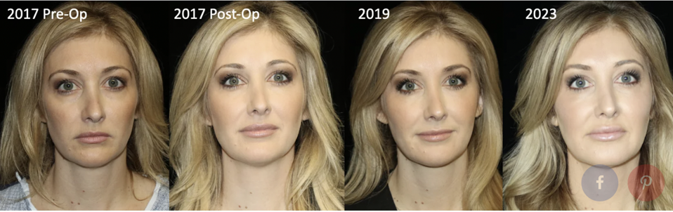 【裁断済み】Aesthetic Plastic Surgery Aesthetic Plastic Surgery with DVD: Expert Consult: Online