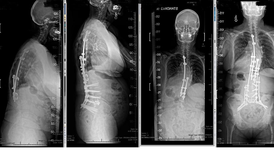 Spine Surgery Patient