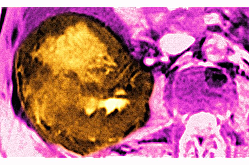 Liver cancer, scan