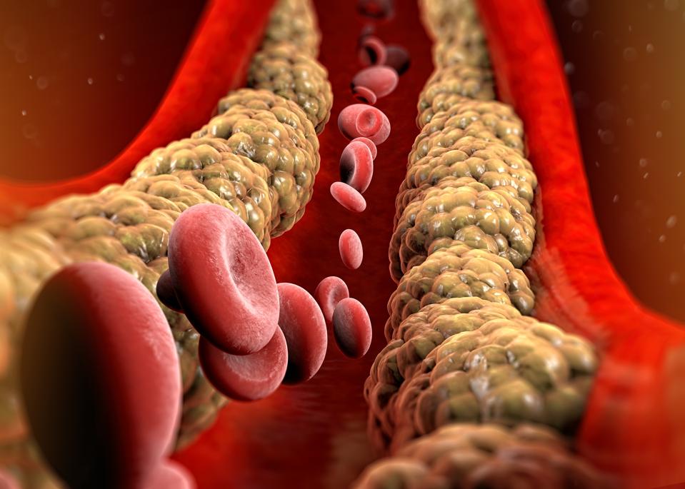 Cholesterol formation, fat, artery, vein, heart. Red blood cells, blood flow. Narrowing of a vein for fat formation