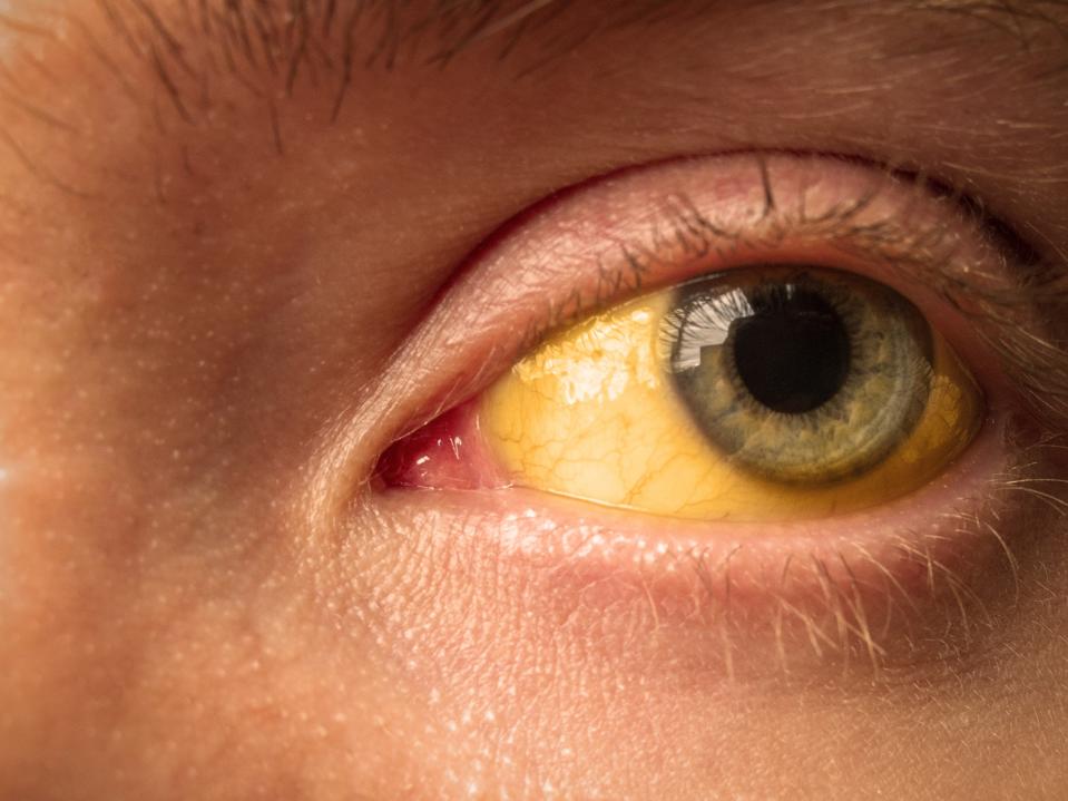 hepatitis