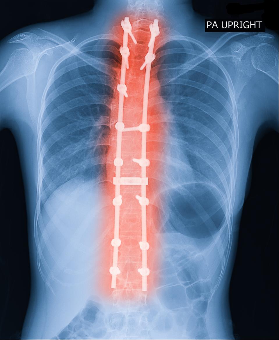 X-ray image of adult patient spine show Scoliosis surgery fix by long metal rod and many screw for spinal bend in adult people. Adult scoliosis fix Medical concept.