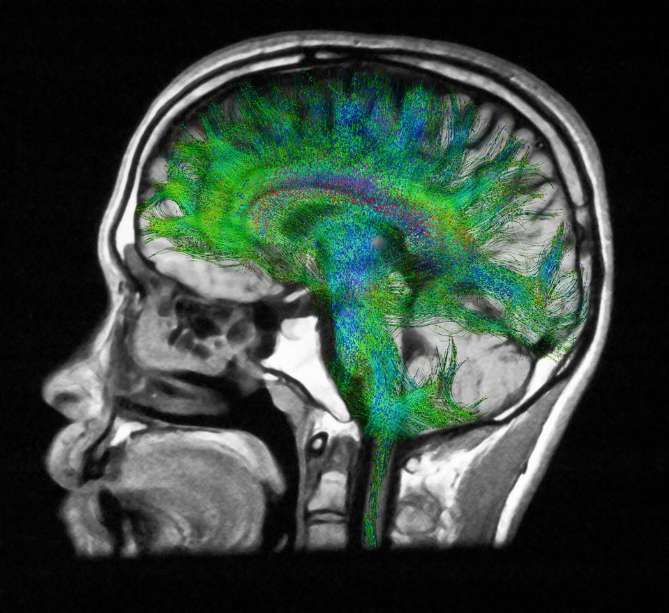 Diffusion MRI, also referred to as diffusion tensor imaging or DTI, of the human brain