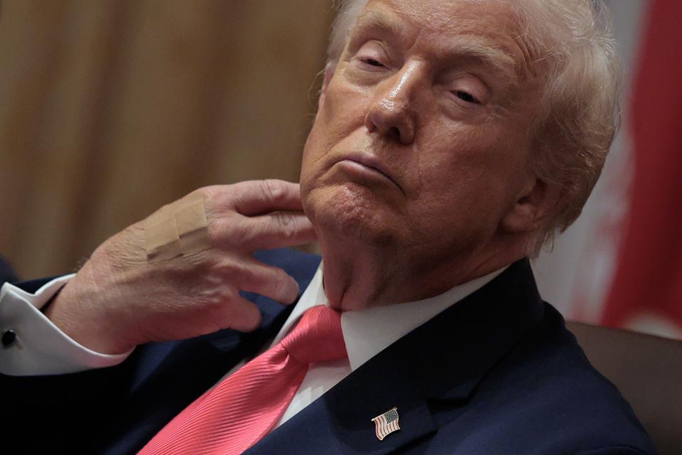 Trump Appears With Bandaged Hand For Second Day In A Row