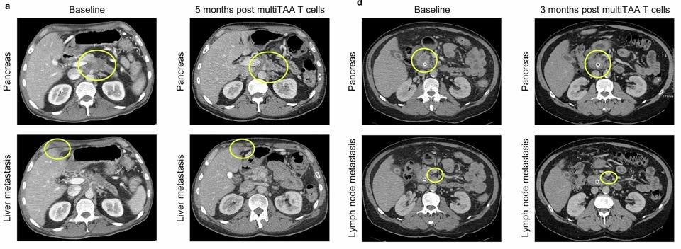 Terapi CAR T Multi-Antigen Beri Harapan Baru untuk Pasien Kanker Pankreas