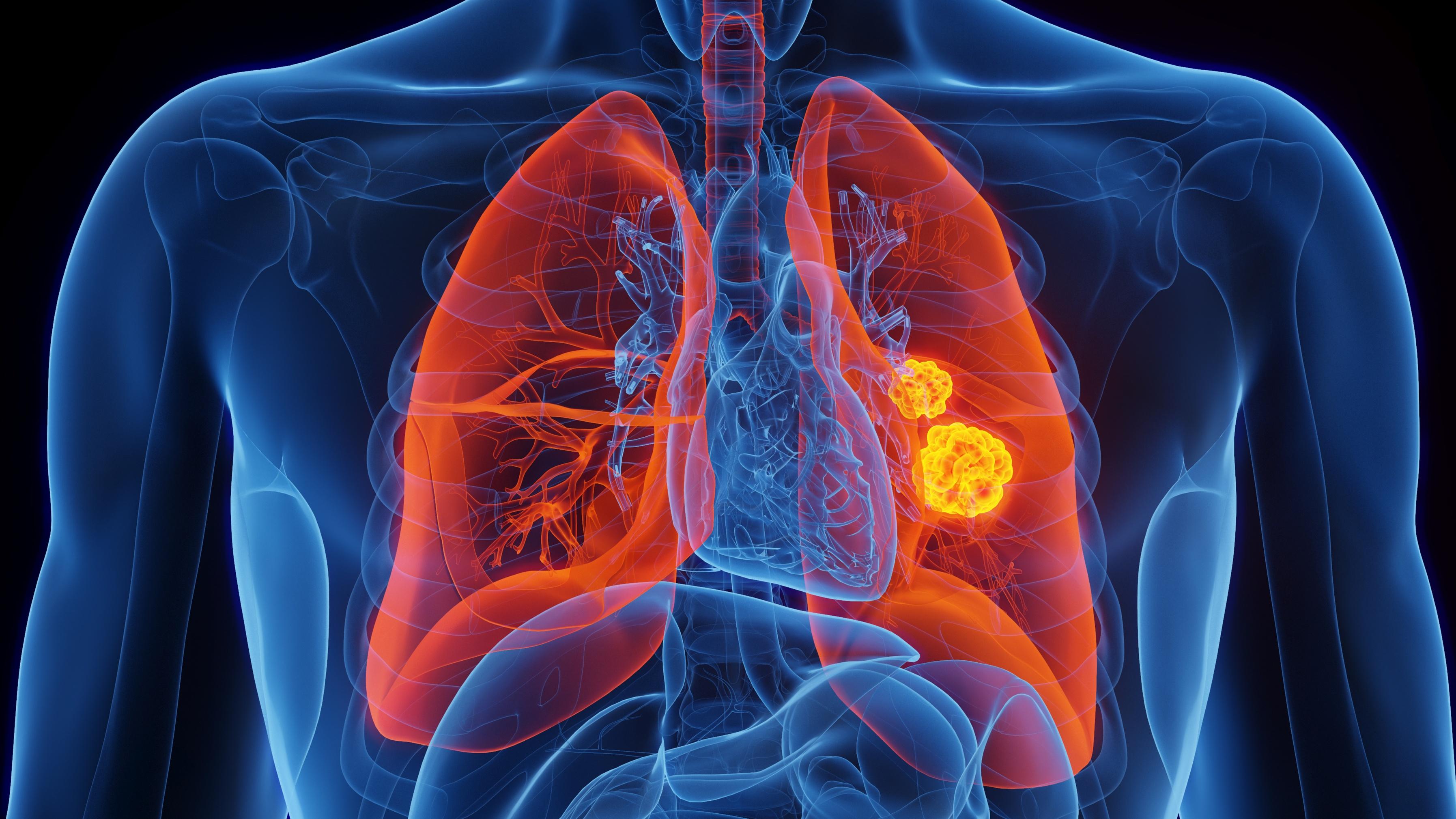 Rare Genetic Mutation Linked To 25-Fold Higher Lung Cancer Risk