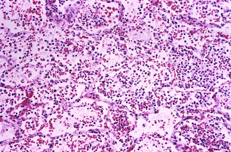 Russian Anti-Plague Laboratory Death Raises Questions On Biosafety And Global Health