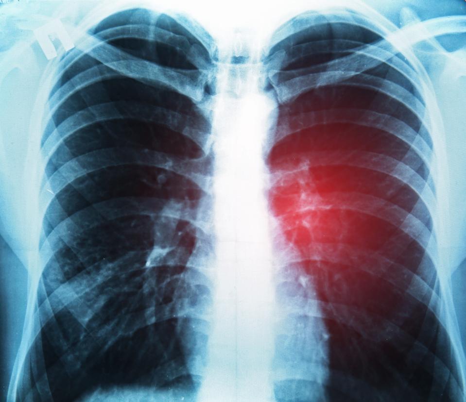 Personalized Cancer Vaccine Company Raises $93 Million Personalized Cancer Vaccine Company Raises $93 Million