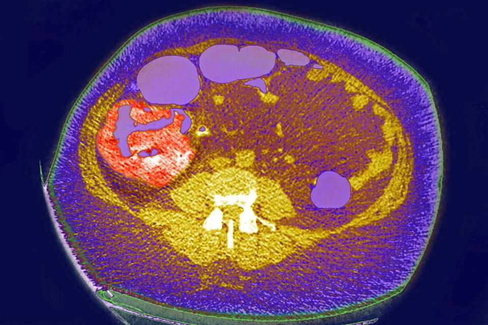 Colon Cancer Ct Scan
